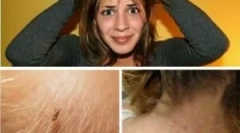 Заштита од вошки: како да се заштитите